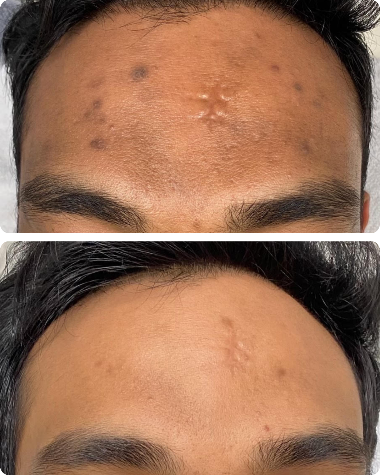 Before and after of a derma peel