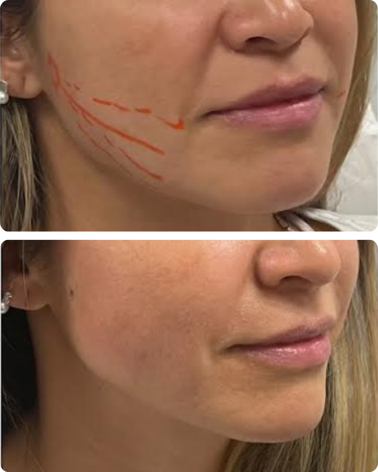 Before and after thread lift